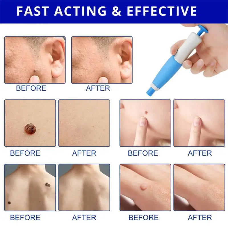 2 In1 Painless Auto Skin Tag Mole Wart Removal Kit Cleaning Tools Face Skin Care Body Wart Dot Treatments Remover Beauty Health