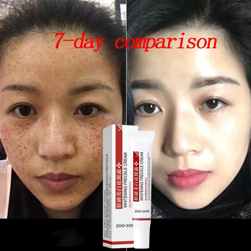 Face Melasma Cream Brightening Dark Skin Remove Black Dots Lightening Melanin Brighten Cream For Dull Skin  Moisturizing Product